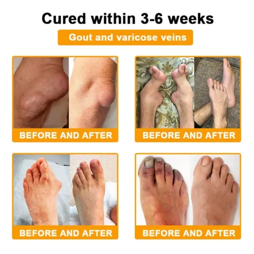 Lotmay® Bee Venom Analgesic Bone Repair Cream